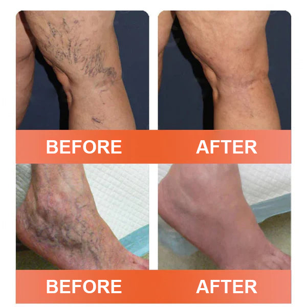 🔥Final 3 Hours: 80% OFF - ODALIT™ Vein Ease Microneedle Care Patch