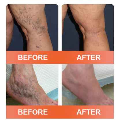 🔥Final 3 Hours: 80% OFF - ODALIT™ Vein Ease Microneedle Care Patch