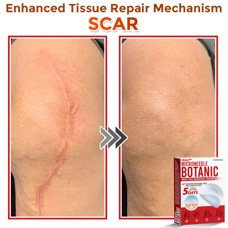🔥Final 3 Hours: 80% OFF - ODALIT™ MicroNeedle Botanic Skin Tag Removal Patch 🇺🇸 Made in the USA