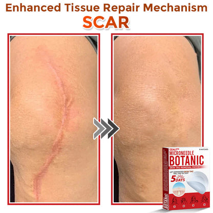 🔥Final 3 Hours: 80% OFF - ODALIT™ MicroNeedle Botanic Skin Tag Removal Patch 🇺🇸 Made in the USA