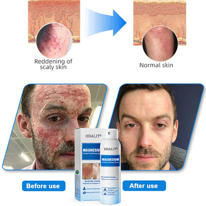 🔥Final 3 Hours: 80% OFF - ODALIT® Magnesium Herbal Soothing Spray
