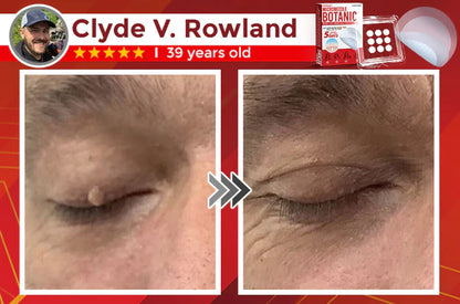 🔥Final 3 Hours: 80% OFF - ODALIT™ MicroNeedle Botanic Skin Tag Removal Patch 🇺🇸 Made in the USA