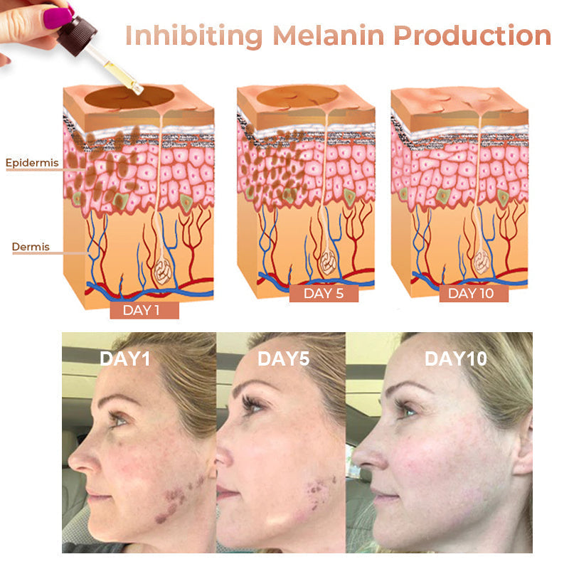 🔥Final 3 Hours: 80% OFF - SEURICO™ Melanin Correcting Facial Serum –  Rapid Dark Spot Eraser