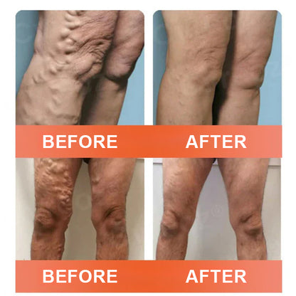 🔥Final 3 Hours: 80% OFF - ODALIT™ Vein Ease Microneedle Care Patch