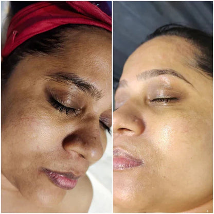 🔥Final 3 Hours: 80% OFF - SEURICO™ Melanin Correcting Facial Serum –  Rapid Dark Spot Eraser
