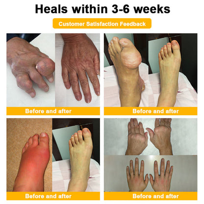 🔥Final 3 Hours: 80% OFF - ODALIT™ Botulinum Toxin & Bee Venom Pain-Relief Bone Healing Cream🐝
