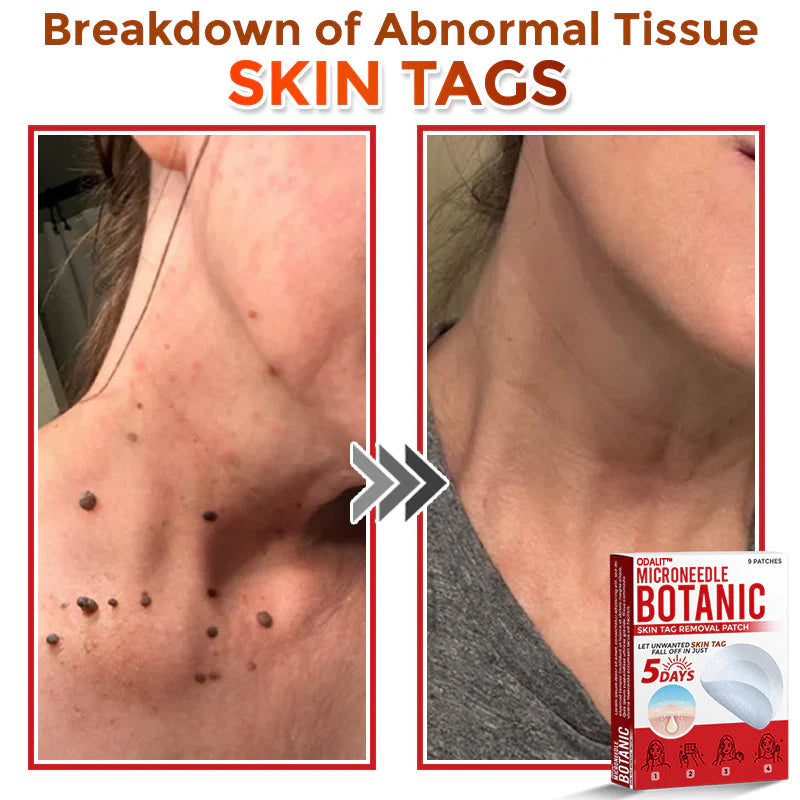 🔥Final 3 Hours: 80% OFF - ODALIT™ MicroNeedle Botanic Skin Tag Removal Patch 🇺🇸 Made in the USA
