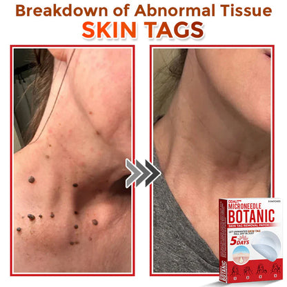 🔥Final 3 Hours: 80% OFF - ODALIT™ MicroNeedle Botanic Skin Tag Removal Patch 🇺🇸 Made in the USA