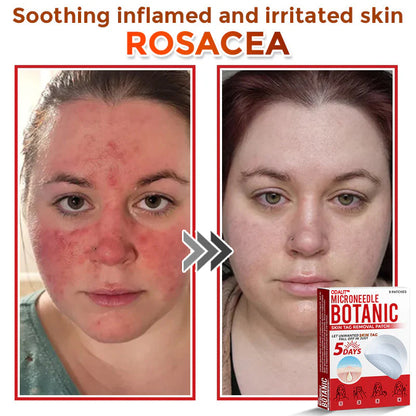 🔥Final 3 Hours: 80% OFF - ODALIT™ MicroNeedle Botanic Skin Tag Removal Patch 🇺🇸 Made in the USA
