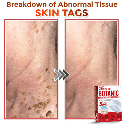 🔥Final 3 Hours: 80% OFF - ODALIT™ MicroNeedle Botanic Skin Tag Removal Patch 🇺🇸 Made in the USA