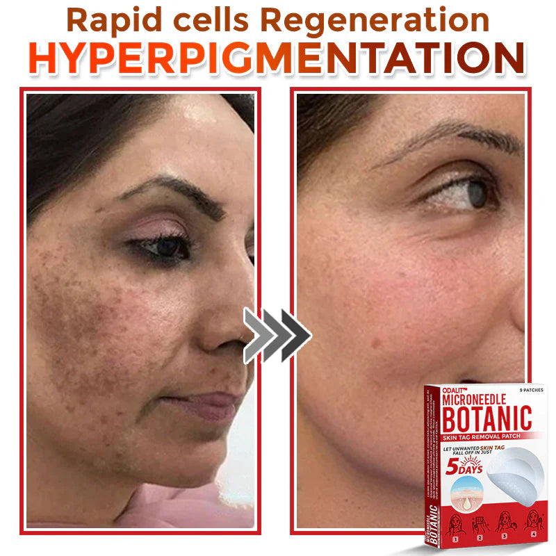 🔥Final 3 Hours: 80% OFF - ODALIT™ MicroNeedle Botanic Skin Tag Removal Patch 🇺🇸 Made in the USA