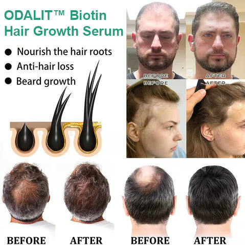 🔥Final 3 Hours: 80% OFF - ODALIT™ Biotin Hair Growth Serum