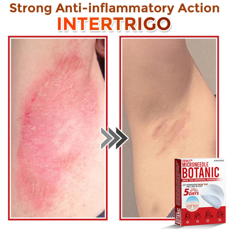 🔥Final 3 Hours: 80% OFF - ODALIT™ MicroNeedle Botanic Skin Tag Removal Patch 🇺🇸 Made in the USA