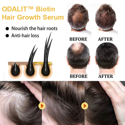 🔥Final 3 Hours: 80% OFF - ODALIT™ Biotin Hair Growth Serum