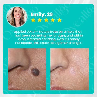 ✅ Official Store: ODALIT™ NatureErase Instant Alligator Oil Mole & Spot Removal Plus Gel