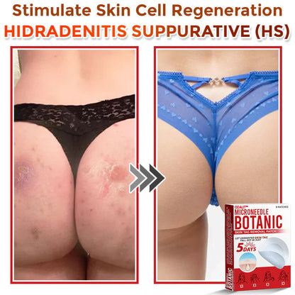 🔥Final 3 Hours: 80% OFF - ODALIT™ MicroNeedle Botanic Skin Tag Removal Patch 🇺🇸 Made in the USA