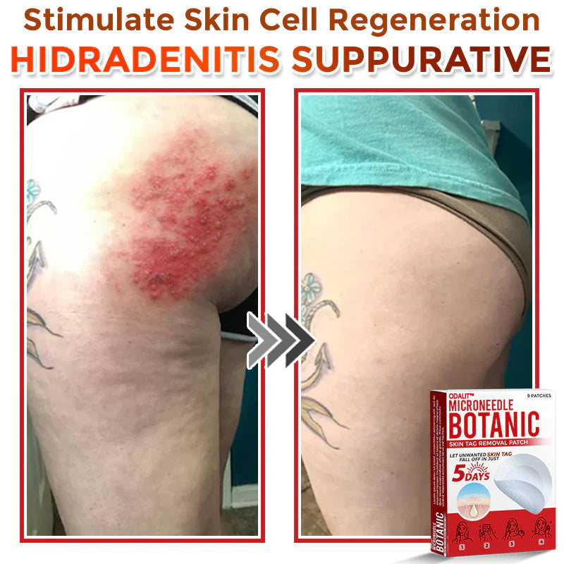 🔥Final 3 Hours: 80% OFF - ODALIT™ MicroNeedle Botanic Skin Tag Removal Patch 🇺🇸 Made in the USA