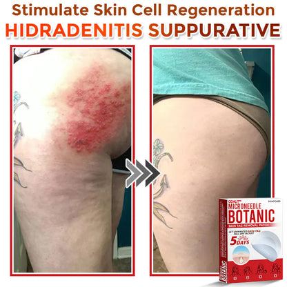🔥Final 3 Hours: 80% OFF - ODALIT™ MicroNeedle Botanic Skin Tag Removal Patch 🇺🇸 Made in the USA