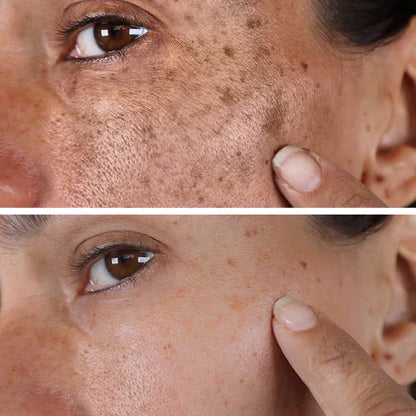 🔥Final 3 Hours: 80% OFF - SEURICO™ Melanin Correcting Facial Serum –  Rapid Dark Spot Eraser