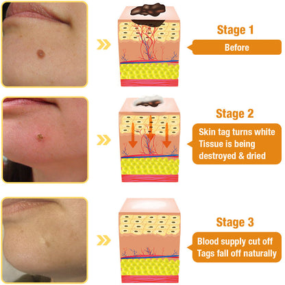 🔥Final 3 Hours: 80% OFF - LBMLBM™ TagRecede Bee Venom Treatment Spray