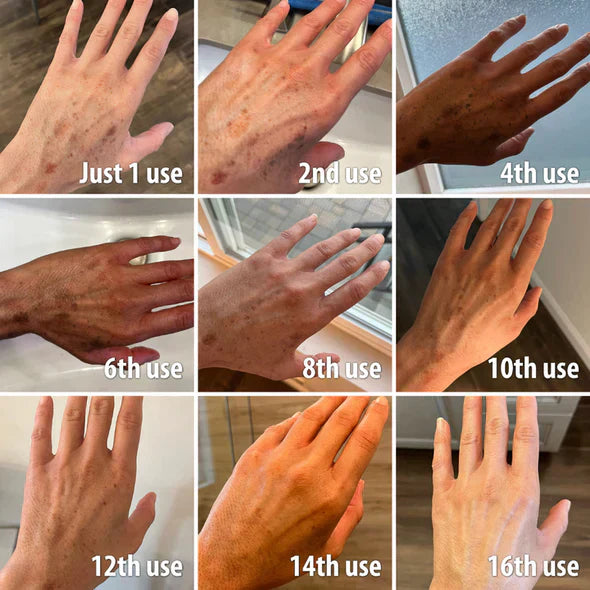 🔥Final 3 Hours: 80% OFF - SEURICO™ Melanin Correcting Facial Serum –  Rapid Dark Spot Eraser